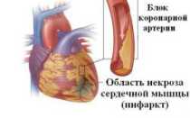 Физические нагрузки после инфаркта миокарда и стентирования