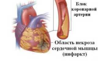 Физические нагрузки после инфаркта миокарда и стентирования