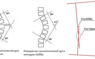 Степени сколиоза: причины и последствия