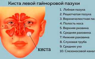 Как распознать и вылечить кисту в носу: полезные советы и рекомендации