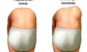 Как исправить сколиотическую осанку для здоровья и комфорта