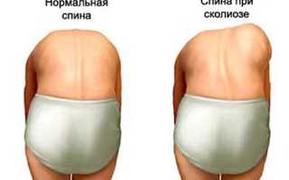 Как исправить сколиотическую осанку для здоровья и комфорта