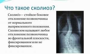 Последствия сколиоза для здоровья человека