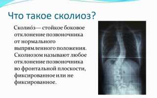 Последствия сколиоза для здоровья человека