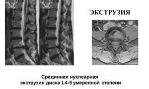Дорзальная экструзия диска: особенности и преимущества