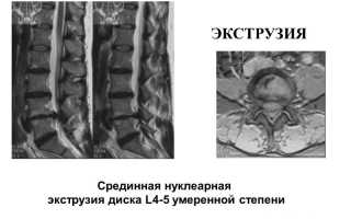 Дорзальная экструзия диска: особенности и преимущества