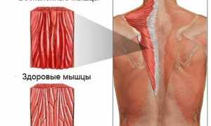 Миозит мышц спины: причины и лечение