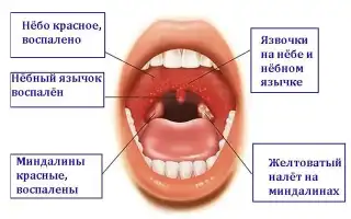 Особенности развития герпесной ангины у детей и взрослых