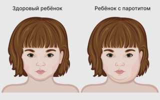 Последствия для мужчин болезни свинка: здоровье и рекомендации