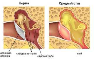 Принципы лечения и симптомы хронического отита среднего уха: важные аспекты и рекомендации