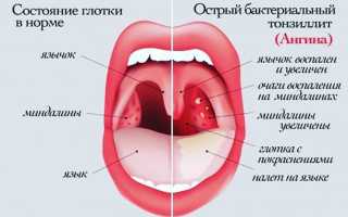 Методы лечения ангины без использования антибиотиков в домашних условиях