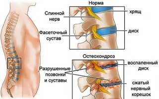 Больничный при остеохондрозе: важные аспекты и рекомендации