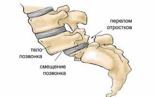 Смещение позвонков поясничного отдела — симптомы и лечение, советы специалистов