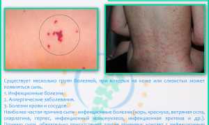 Сыпь на спине: причины и лечение