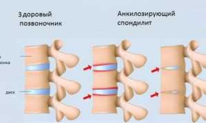 Анкилозирующий спондилит: что это такое и как с ним жить