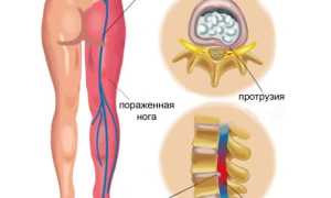 Мази при воспалении седалищного нерва: эффективные решения для облегчения боли