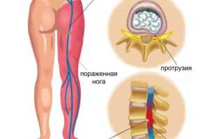 Мази при воспалении седалищного нерва: эффективные решения для облегчения боли