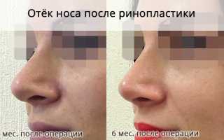 Опасен ли отек кончика носа после проведения ринопластики? Важные аспекты