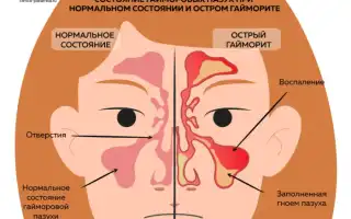 Методы борьбы с гайморитом во время беременности: советы и рекомендации