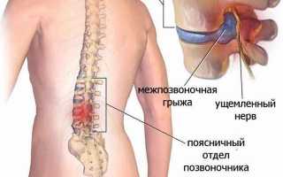 Операция по удалению грыжи поясничного отдела позвоночника: важные аспекты и рекомендации