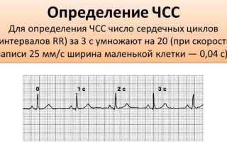 Расшифровка экг для чайников