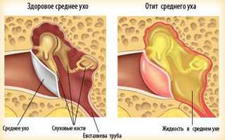 Чем лечить отит при беременности