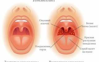 Что можно сделать, если гланды опухли, для облегчения состояния