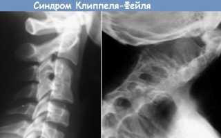 Конкресценция шейных позвонков: причины и последствия