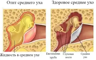 Возможные риски при шунтировании барабанной перепонки в детском возрасте: важные аспекты