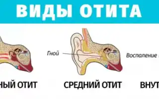 Терапия наружного отита у взрослых: эффективные методы и рекомендации