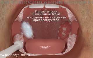 Преимущества и недостатки криодеструкции миндалин для здоровья