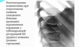 Боль в спине при наклонах: причины и рекомендации