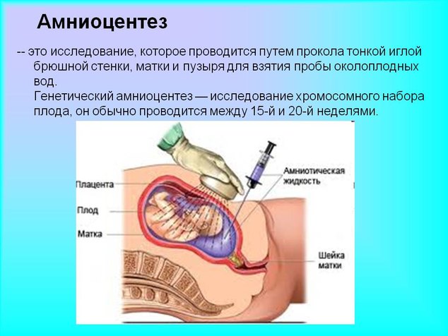 Процедура амниоцентеза