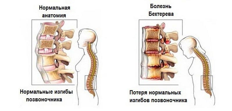 Болезнь Бехтерева - патология, характеризующаяся поражением позвоночных суставов и прилегающих к ним тканей