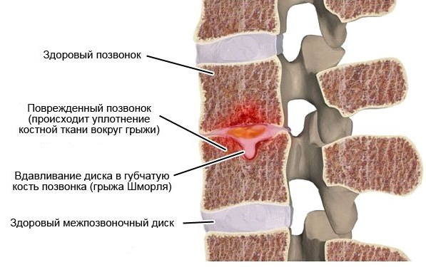 Заболевание никак не проявляется, пока грыжа не увеличится до критических размеров