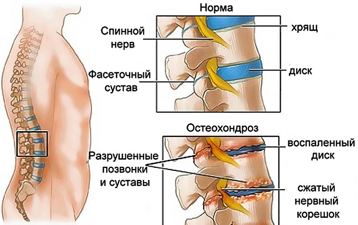 Чаще других при остеохондрозе страдают кости и связки. На данный момент от 40 до 90 процентов людей земного шара испытывают симптомы этого заболевания