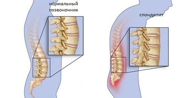 Спондилит поясничного отдела позвоночника – неприятное заболевание, которое, к сожалению, может возникнуть у каждого