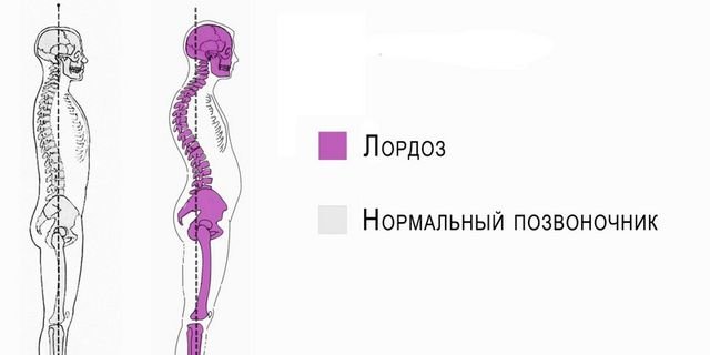 Если проблемы с тем, что голова не держится прямо – то скорее всего у вас лордоз