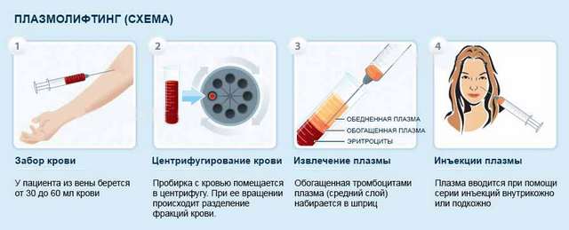 Плазмотерапия