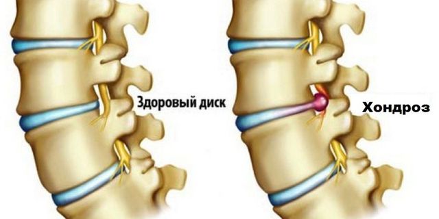 Хондроз – одно из самых страшных заболеваний позвоночника
