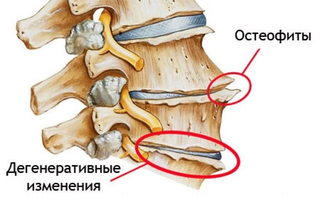 Остеофит – причина появления более серьёзных заболеваний позвоночника
