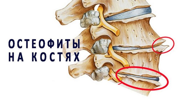 Остеофиты начинают появляться чаще всего из-за чрезмерного давления на позвонки – это защитная реакция организма