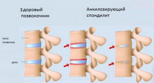 При анкилозирующем спондилите позвонки, межпозвоночные диски и суставы постепенно срастаются между собой