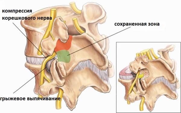 Грыжа позвоночника чаще всего развивается из-за сильных физических нагрузок или травм