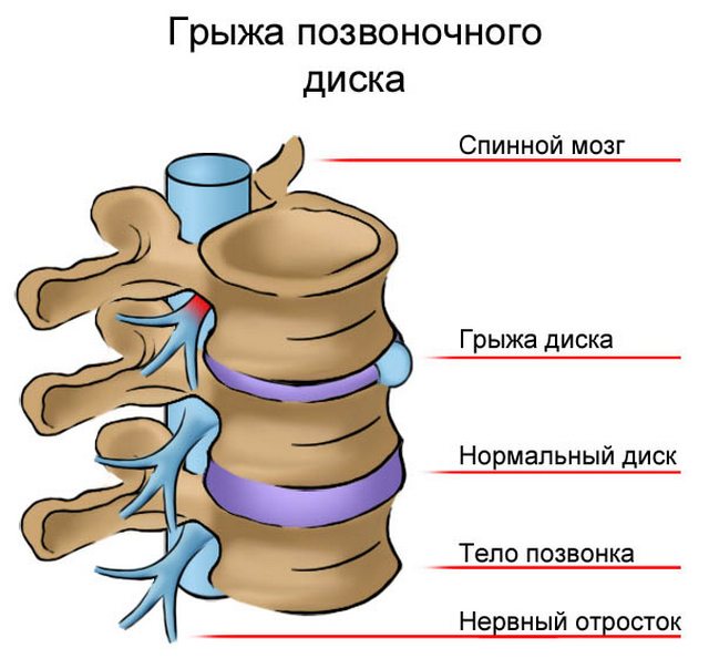 Схематичное изображение грыжи позвоночного диска