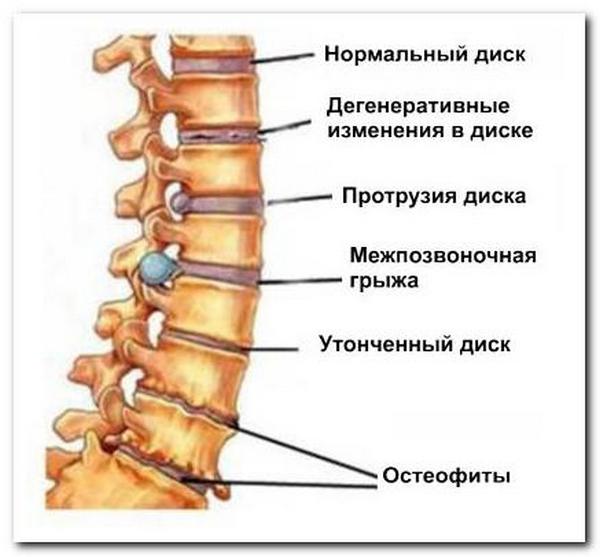 Выделяют несколько стадий остеохондроза