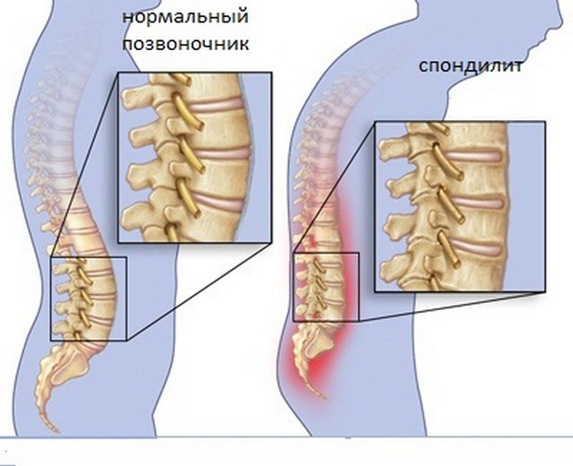 Анкилозирующий спондилит буквально заставляет человека ходить «согнутым» и испытывать постоянные болевые ощущения