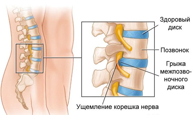 Межпозвоночная грыжа – достаточно частая причина защемленного нерва