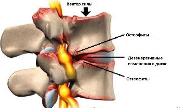 Остеофит – ужасная болезнь, которая, судя по всему, появляется отовсюду