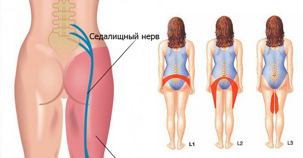 Причин у воспаления седалищного нерва немало